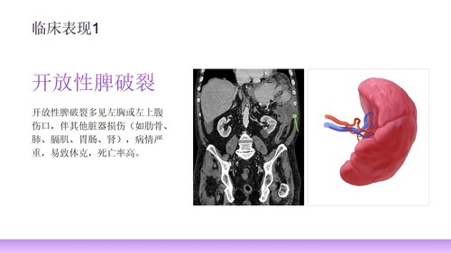 a0277 脾破裂患者的护理PPT课件33页可编辑无水印直接可用 第10页