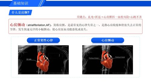 a0278 认识心房颤动PPT课件16页可编辑无水印直接可用 第8页