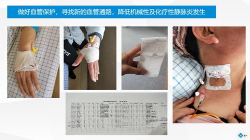 a0282 PDCA-降低住院患者化疗期间静脉炎的发生率PPT课件46页可编辑无水印直接可用 第16页