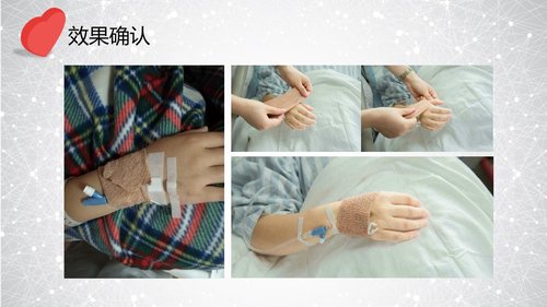 a0303 提高孕妇从穿刺到分娩后留置针的完好率PPT课件34页可编辑无水印直接可用 第17页