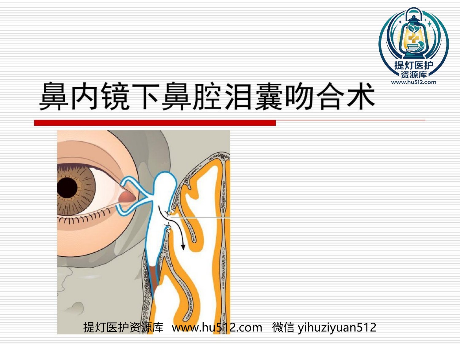 a00634 鼻内镜鼻腔泪囊吻合术PPT医学共23页 20页PPT文档可编辑无水印直接可用