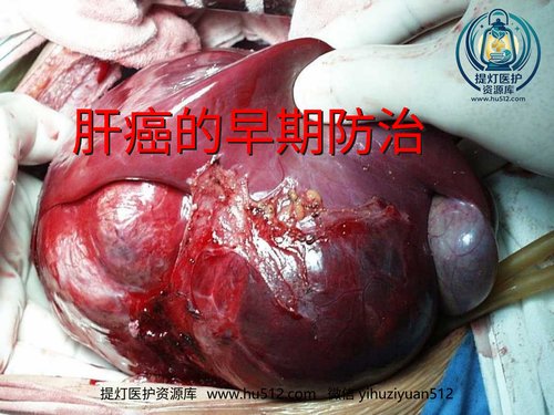 a00894 肝癌的早期防治 20页PPT文档可编辑无水印直接可用