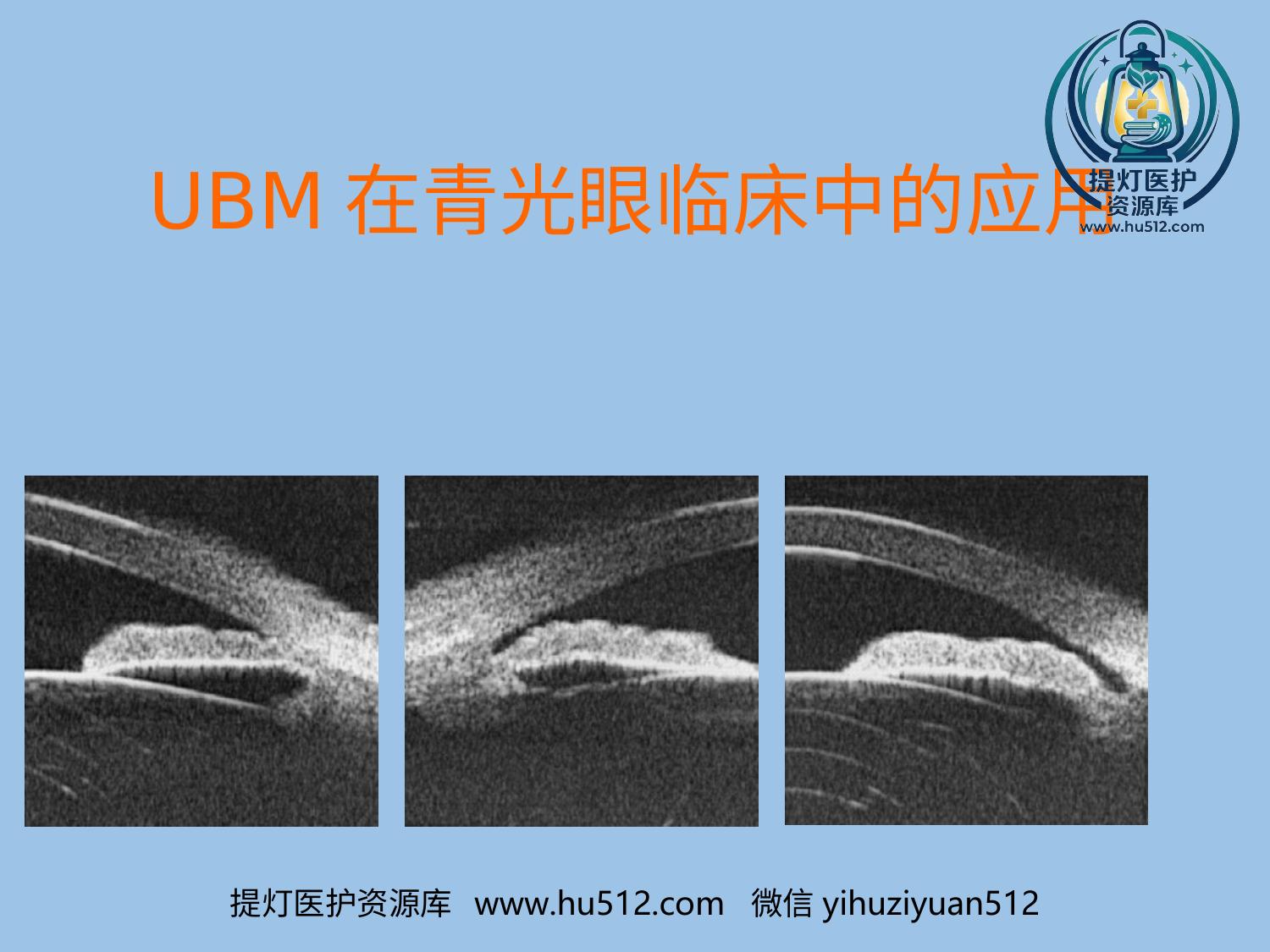a01089 UBM在青光眼临床中应用 20页PPT文档可编辑无水印直接可用