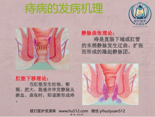 a01462 RPH治疗混合痔临床应用 57页PPT课件可编辑无水印直接可用